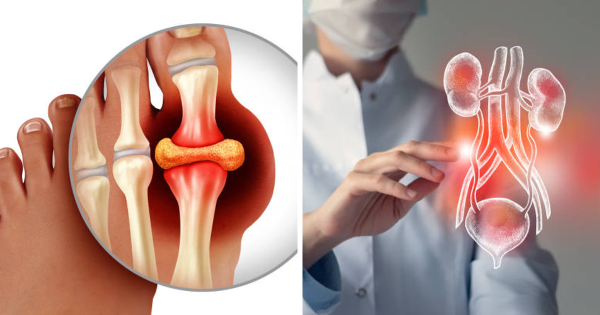 benefits of molybdenum: gout attack prevention